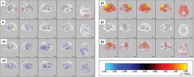 Resting-state electroencephalogram in drug-free subjects with at-risk mental states who later developed psychosis: a low-resolution electromagnetic tomography analysis